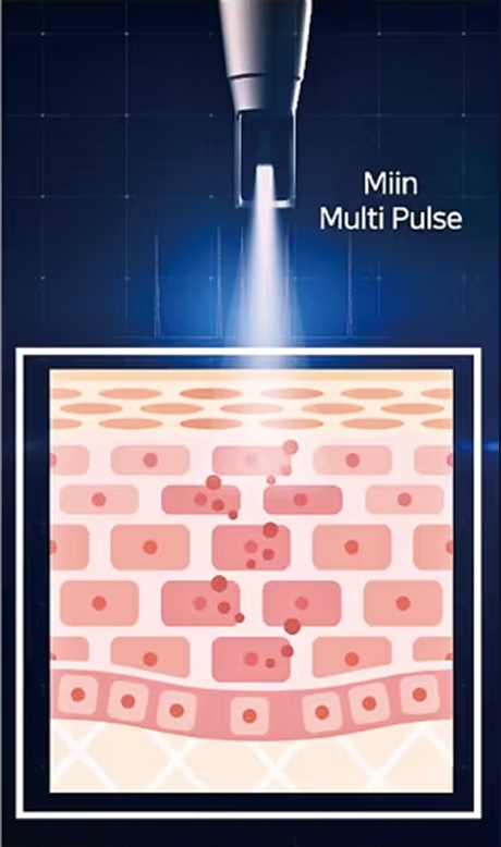 Multi Pulse